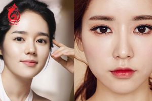 Thái dương bị hóp là gì?
